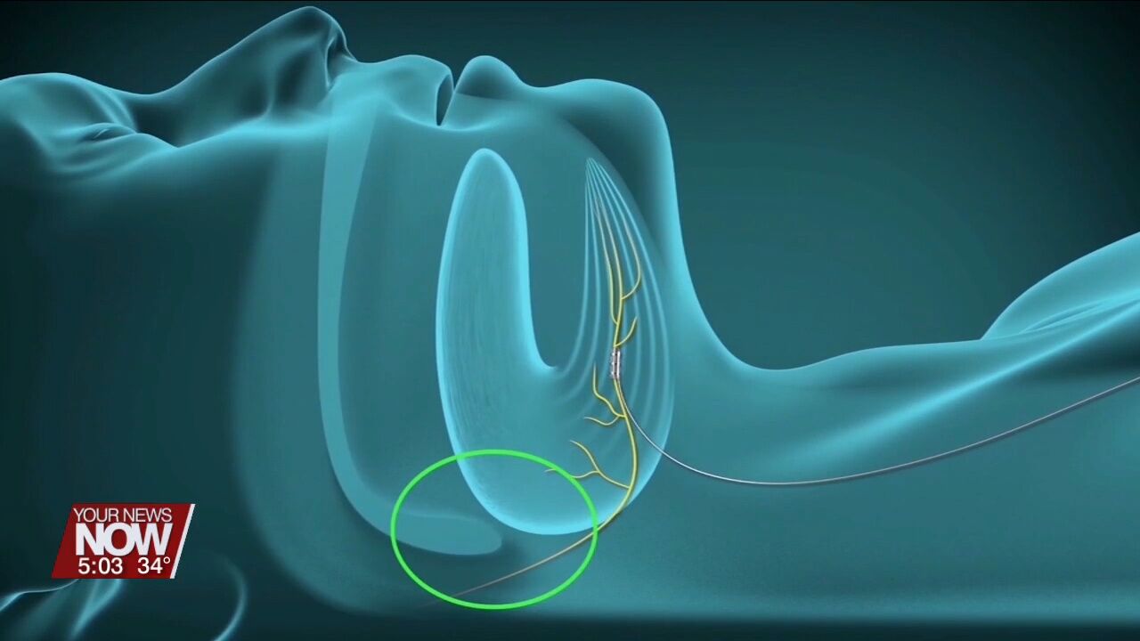 New treatment option available locally for those suffering from sleep apnea